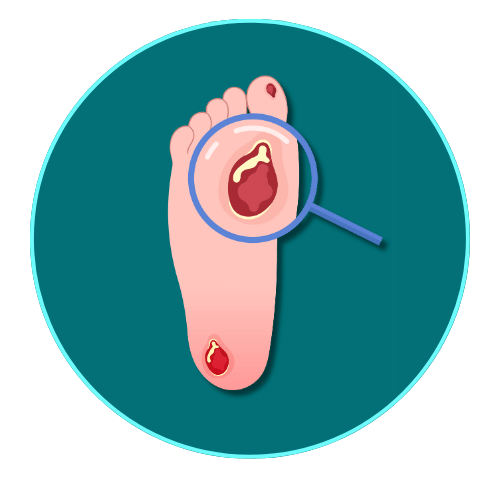 Diabetic foot wounds