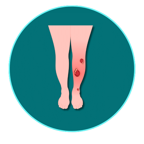 Venous leg ulcers